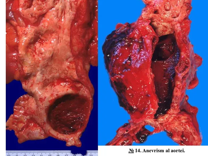№ 14. Anevrism al aortei.