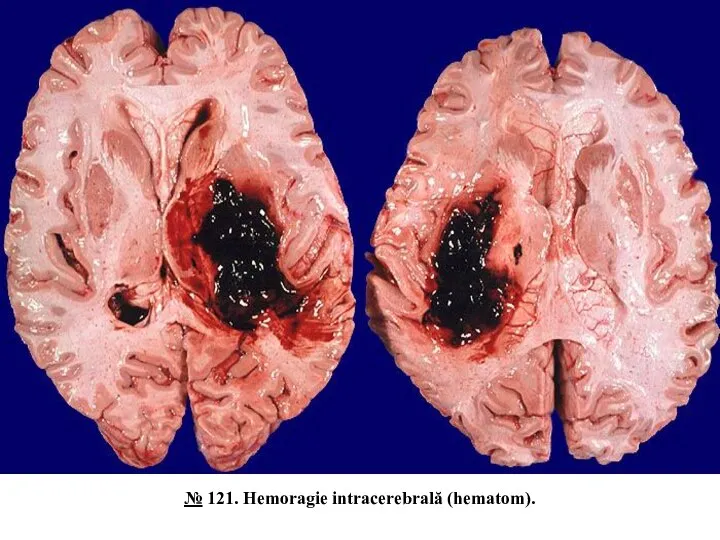 № 121. Hemoragie intracerebrală (hematom).