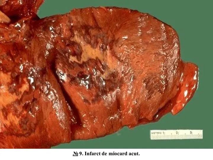 № 9. Infarct de miocard acut.