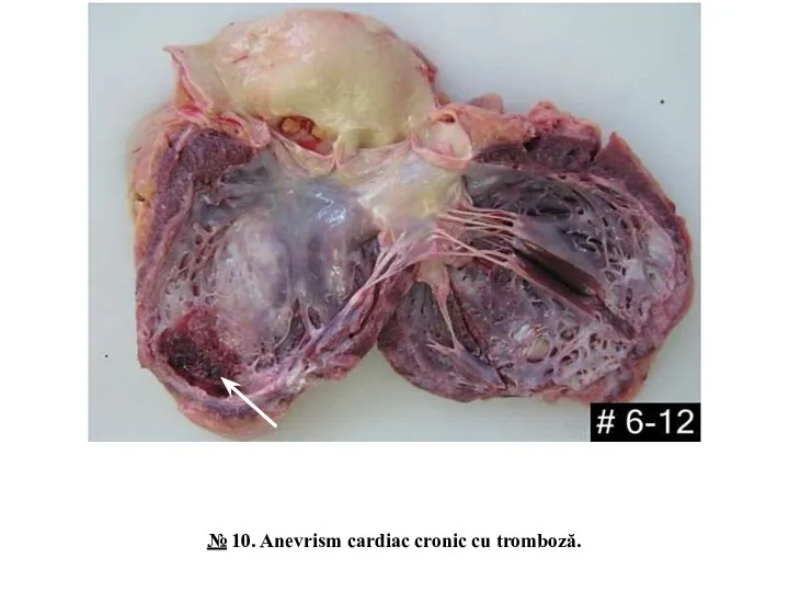 № 10. Anevrism cardiac cronic cu tromboză.