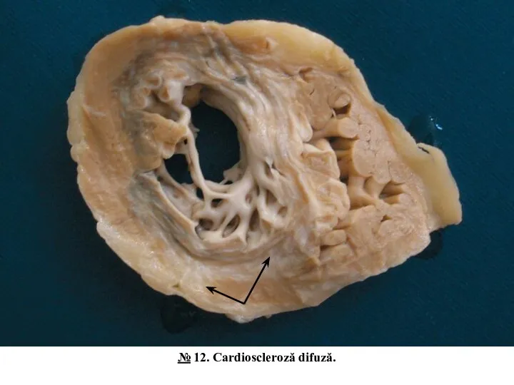 № 12. Cardioscleroză difuză.