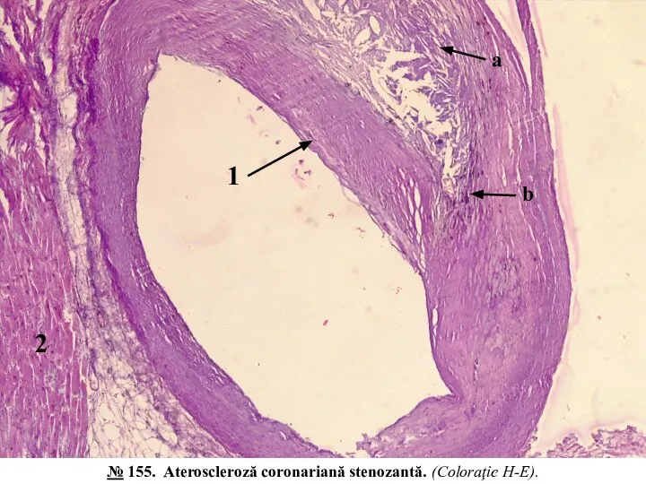 1 b 2 a № 155. Ateroscleroză coronariană stenozantă. (Coloraţie H-E).