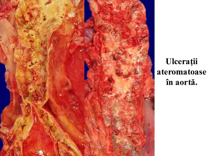 Ulceraţii ateromatoase în aortă.