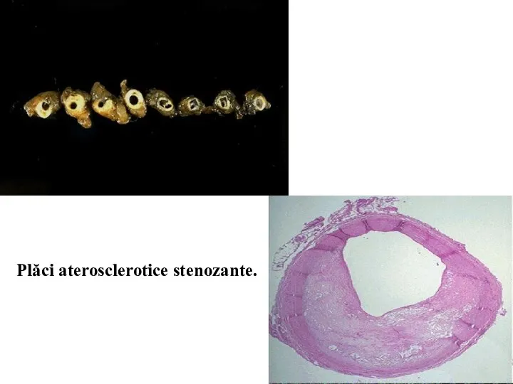Plăci aterosclerotice stenozante.