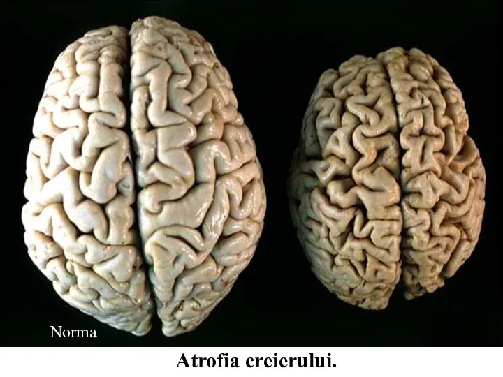 Atrofia creierului. Norma