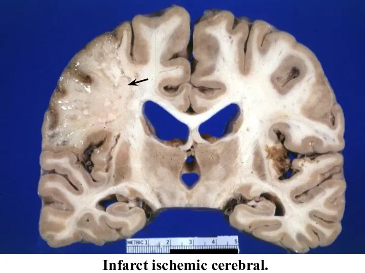 Infarct ischemic cerebral.