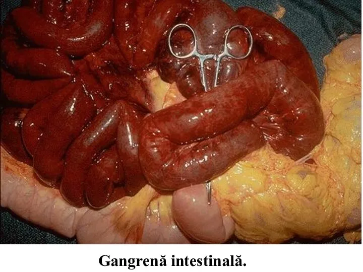 Gangrenă intestinală.