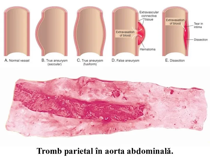 Tromb parietal în aorta abdominală.