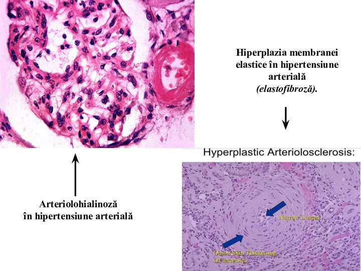 Arteriolohialinoză în hipertensiune arterială Hiperplazia membranei elastice în hipertensiune arterială (elastofibroză).