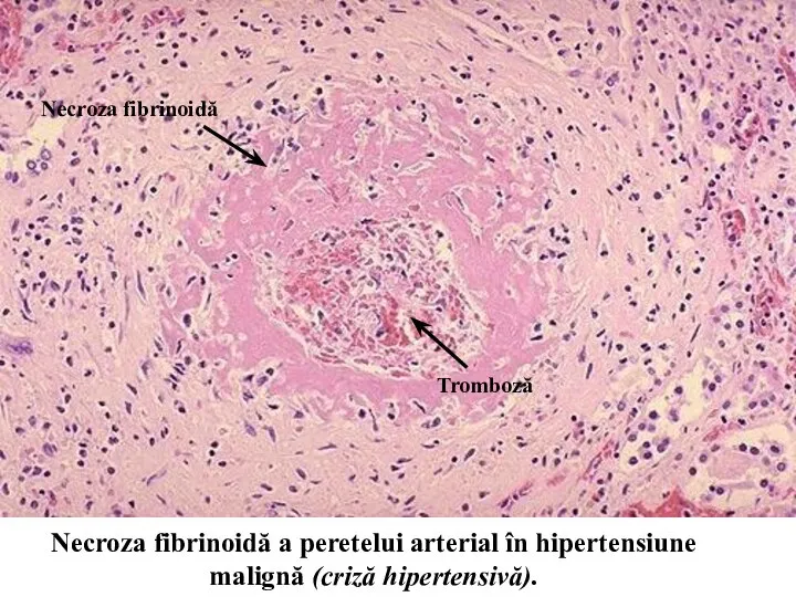 Necroza fibrinoidă Tromboză Necroza fibrinoidă a peretelui arterial în hipertensiune malignă (criză hipertensivă).