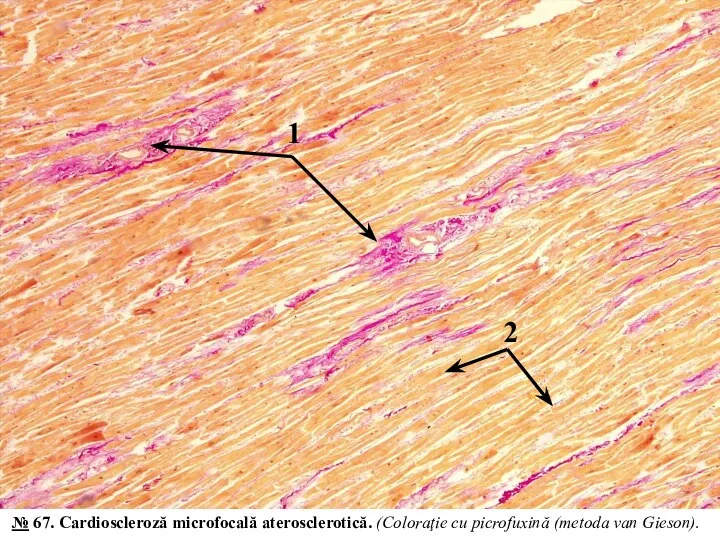 2 1 № 67. Cardioscleroză microfocală aterosclerotică. (Coloraţie cu picrofuxină (metoda van Gieson).