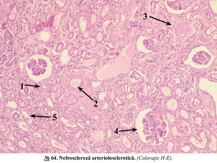 1 3 2 5 4 № 64. Nefroscleroză arteriolosclerotică. (Coloraţie H-E).