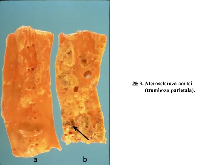 a b № 3. Ateroscleroza aortei (tromboza parietală).