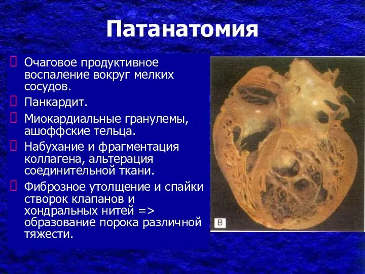 Патанатомия Очаговое продуктивное воспаление вокруг мелких сосудов. Панкардит. Миокардиальные гранулемы, ашоффские тельца.