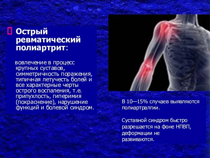 Острый ревматический полиартрит: вовлечение в процесс крупных суставов, симметричность поражения, типичная летучесть