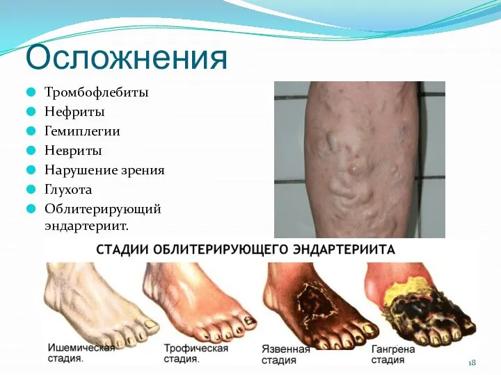 Осложнения Тромбофлебиты Нефриты Гемиплегии Невриты Нарушение зрения Глухота Облитерирующий эндартериит.