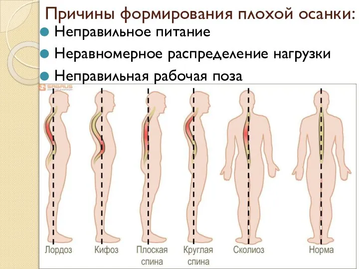 Причины формирования плохой осанки: Неправильное питание Неравномерное распределение нагрузки Неправильная рабочая поза