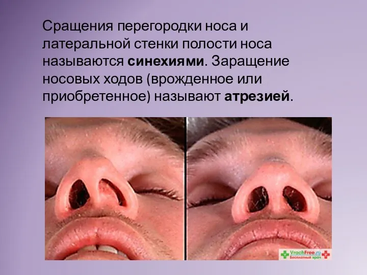 Сращения перегородки носа и латеральной стенки полости носа называются синехиями. Заращение носовых