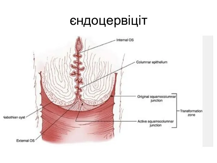 єндоцервіціт