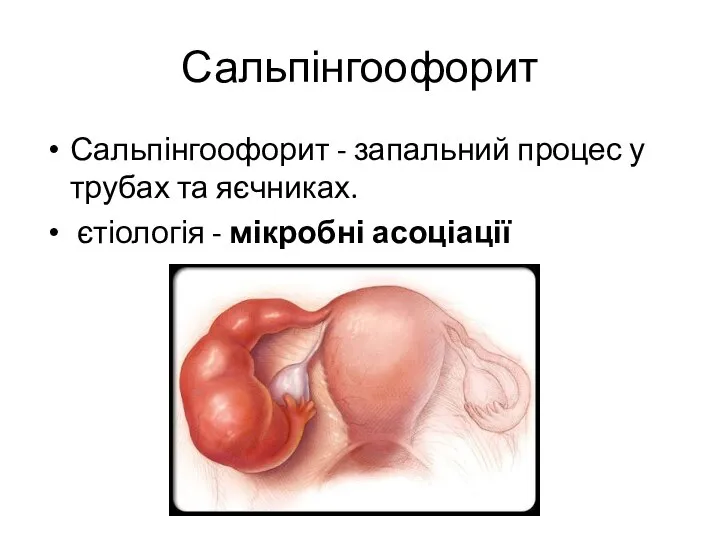 Сальпінгоофорит Сальпінгоофорит - запальний процес у трубах та яєчниках. єтіологія - мікробні асоціації