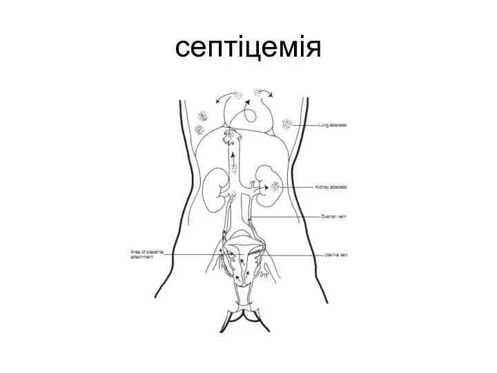 септіцемія