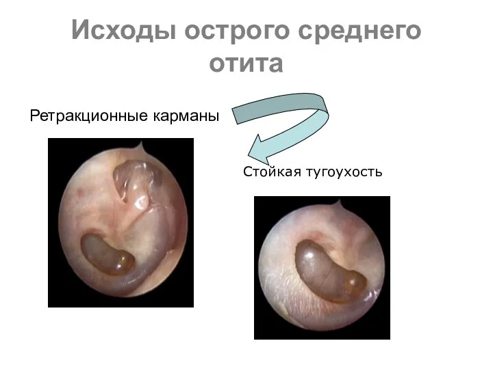 Исходы острого среднего отита Ретракционные карманы Стойкая тугоухость