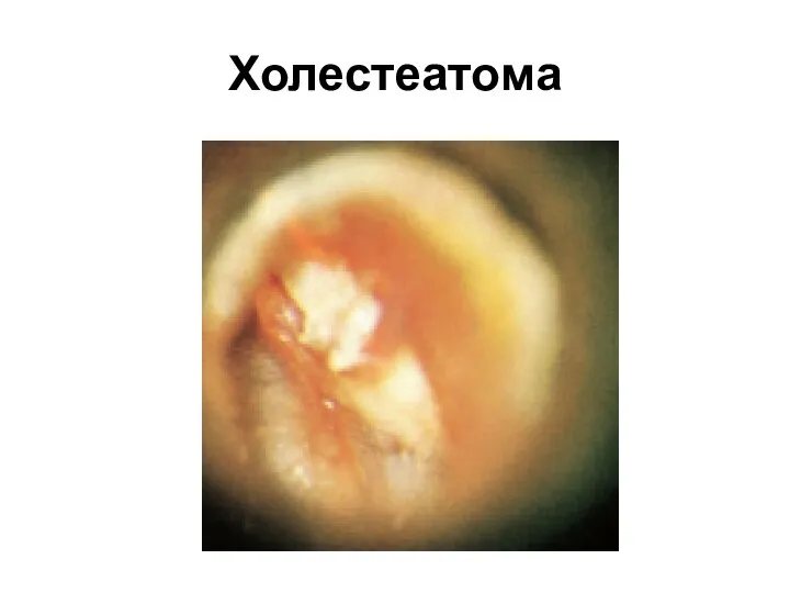 Холестеатома