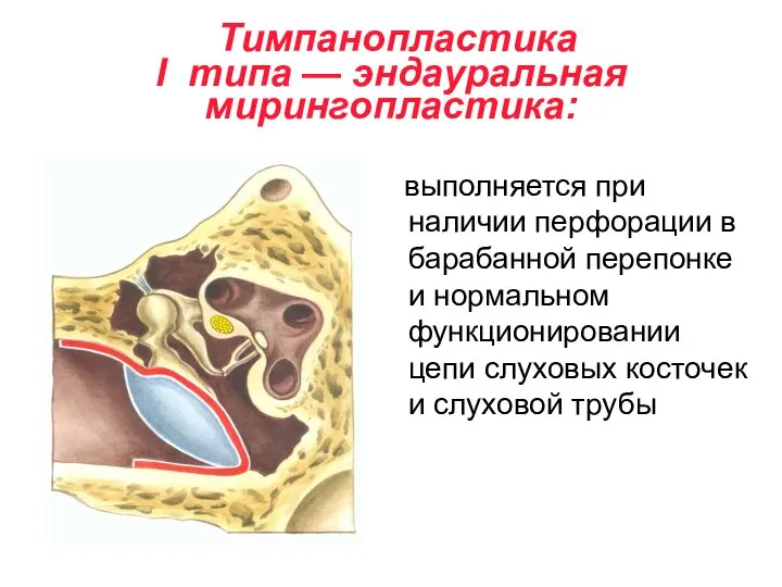 Тимпанопластика I типа — эндауральная мирингопластика: выполняется при наличии перфорации в барабанной