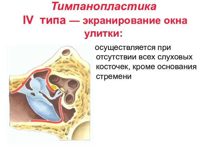 Тимпанопластика IV типа — экранирование окна улитки: осуществляется при отсутствии всех слуховых косточек, кроме основания стремени