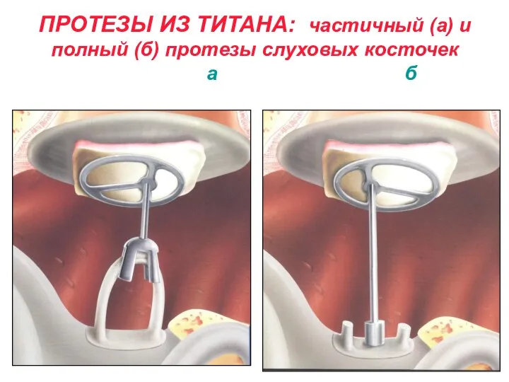 ПРОТЕЗЫ ИЗ ТИТАНА: частичный (а) и полный (б) протезы слуховых косточек а б