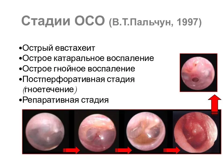 Стадии ОСО (В.Т.Пальчун, 1997) Острый евстахеит Острое катаральное воспаление Острое гнойное воспаление