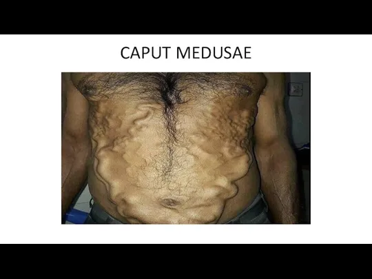 CAPUT MEDUSAE