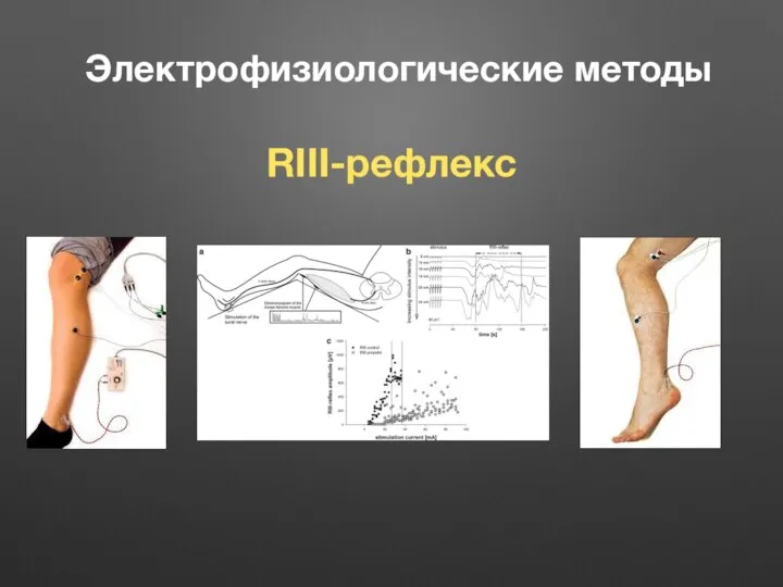 Электрофизиологические методы RIII-рефлекс