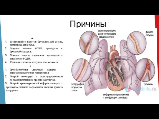 Причины А. Затянувшийся приступ бронхиальной астмы, астматический статус. Тяжелое течение ХОБЛ, приведшее