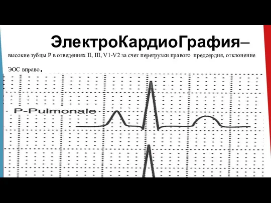 ЭлектроКардиоГрафия– высокие зубцы Р в отведениях II, III, V1-V2 за счет перегрузки