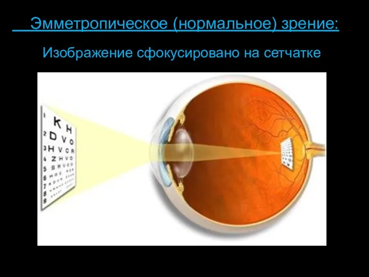 Изображение сфокусировано на сетчатке Эмметропическое (нормальное) зрение: