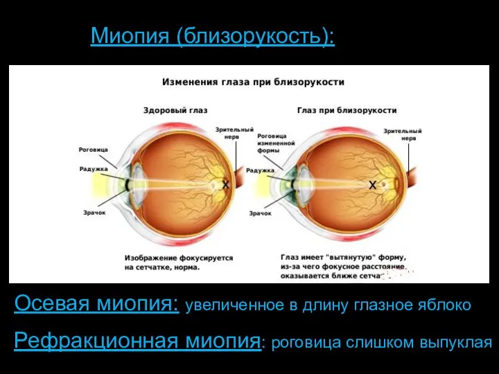 Length of Eyeball + Curvature of Cornea Миопия (близорукость): Осевая миопия: увеличенное