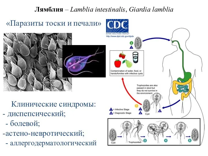 Лямблия – Lamblia intestinalis, Giardia lamblia «Паразиты тоски и печали» Клинические синдромы: