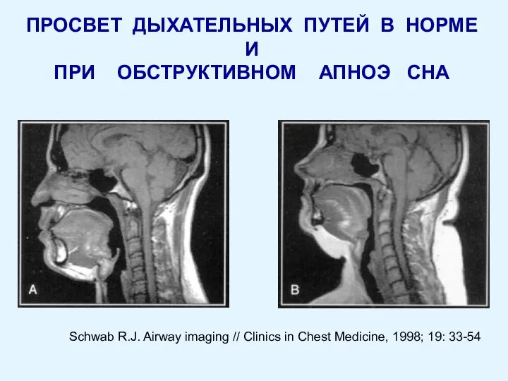 ПРОСВЕТ ДЫХАТЕЛЬНЫХ ПУТЕЙ В НОРМЕ И ПРИ ОБСТРУКТИВНОМ АПНОЭ СНА Schwab R.J.