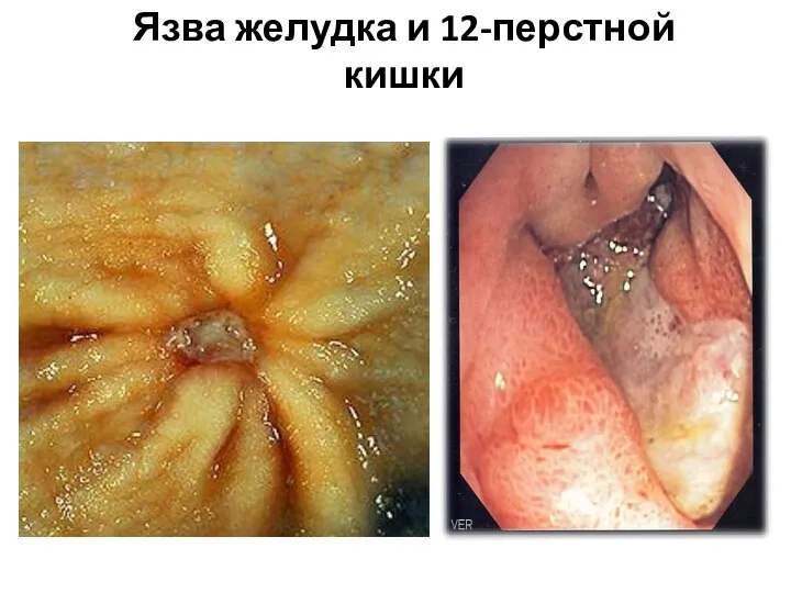 Язва желудка и 12-перстной кишки