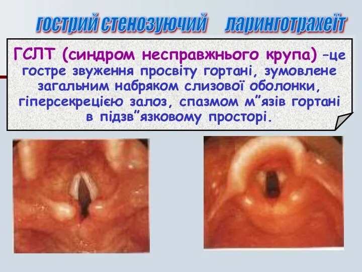 гострий стенозуючий ларинготрахеїт ГСЛТ (синдром несправжнього крупа) –це гостре звуження просвіту гортані,