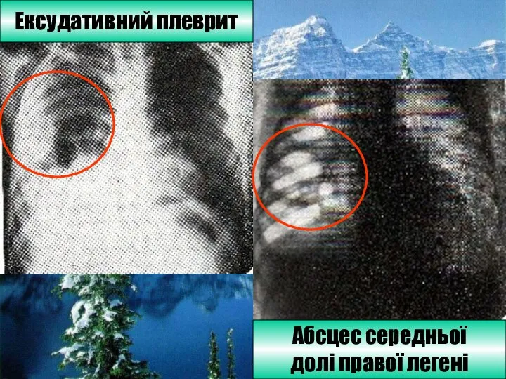 Ексудативний плеврит Абсцес середньої долі правої легені