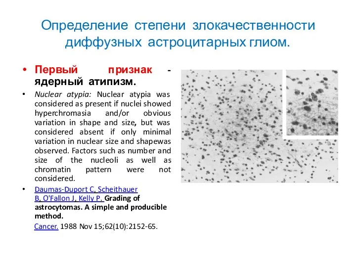 Определение степени злокачественности диффузных астроцитарных глиом. Первый признак - ядерный атипизм. Nuclear