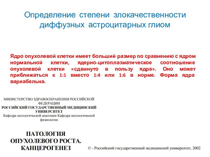 Определение степени злокачественности диффузных астроцитарных глиом Ядро опухолевой клетки имеет больший размер