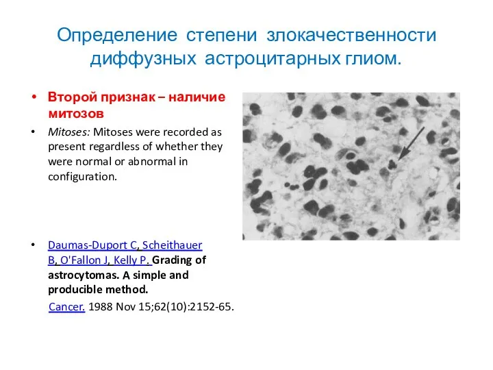 Определение степени злокачественности диффузных астроцитарных глиом. Второй признак – наличие митозов Mitoses: