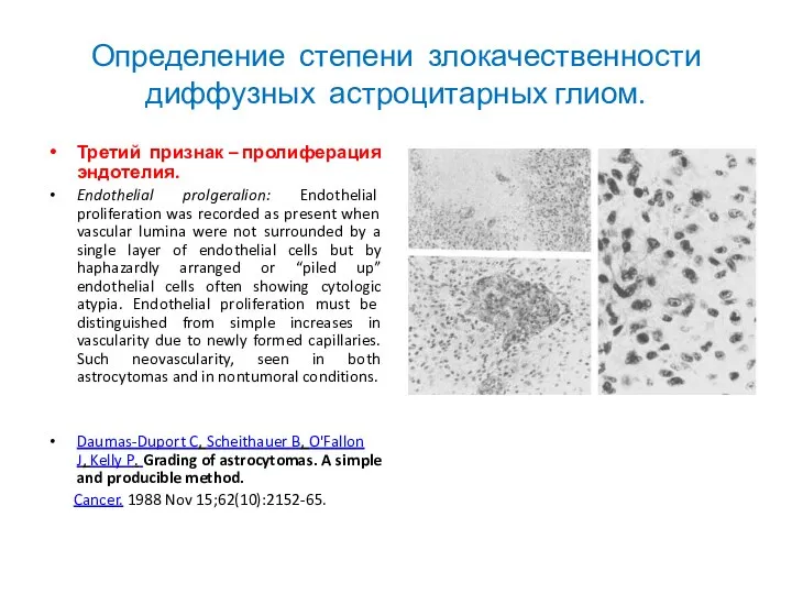 Определение степени злокачественности диффузных астроцитарных глиом. Третий признак – пролиферация эндотелия. Endothelial