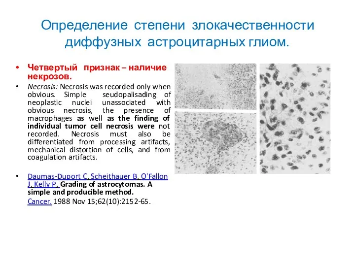 Определение степени злокачественности диффузных астроцитарных глиом. Четвертый признак – наличие некрозов. Necrosis: