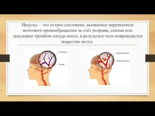 Инсульт – это острое состояние, вызванное нарушением мозгового кровообращения за счёт разрыва,