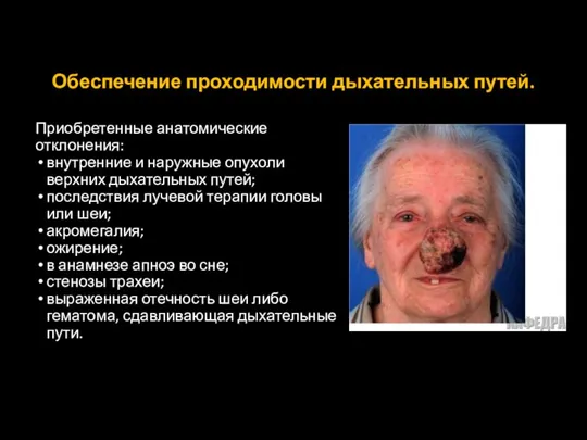 Обеспечение проходимости дыхательных путей. Приобретенные анатомические отклонения: внутренние и наружные опухоли верхних