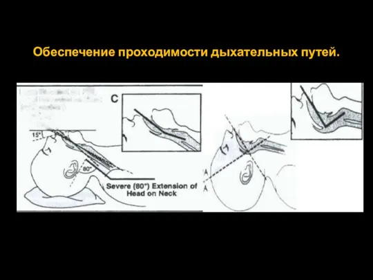 Обеспечение проходимости дыхательных путей.